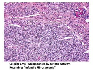 Cellular CMN- Accompanied by Mitotic Activity.
Resembles “Infantile Fibrosarcoma”
 