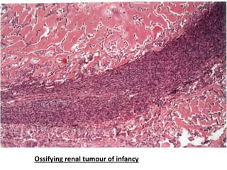 Ossifying renal tumour of infancy
 