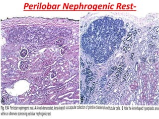 Perilobar Nephrogenic Rest-
.
 