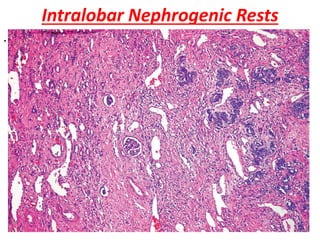 Intralobar Nephrogenic Rests
.
 