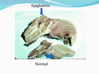 Epiglottitis Normal 