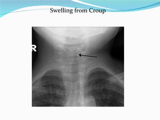 Swelling from Croup 
