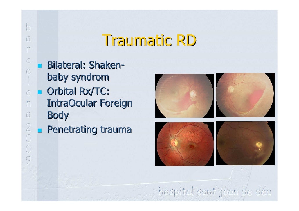 Pediatric retinal detachment