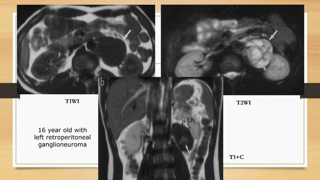 imaging-in-pediatric-retroperitoneal-masses-pptx-medical-health