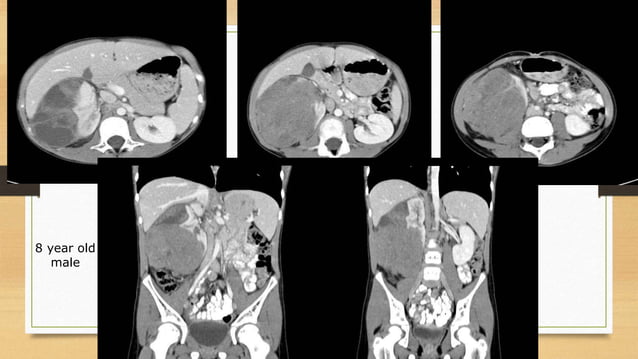 imaging-in-pediatric-retroperitoneal-masses-pptx-medical-health