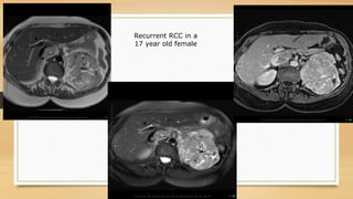 Recurrent Rcc Radiopaedia Imaging in Pediatric Retroperitoneal Masses | PPTX