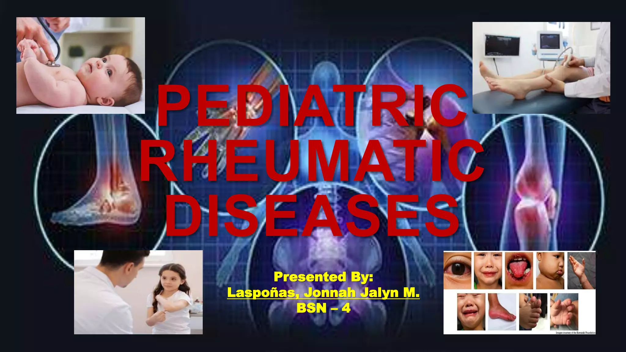 Paediatric Rheumatology Pediatric Rheumatic Diseases by JJ Laspoñas | PPTX