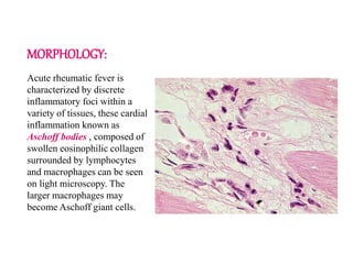 MORPHOLOGY:
Acute rheumatic fever is
characterized by discrete
inflammatory foci within a
variety of tissues, these cardial
inflammation known as
Aschoff bodies , composed of
swollen eosinophilic collagen
surrounded by lymphocytes
and macrophages can be seen
on light microscopy. The
larger macrophages may
become Aschoff giant cells.
 