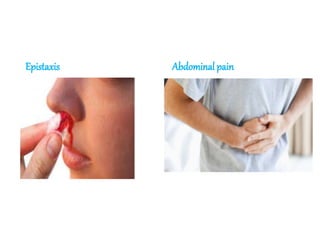 Epistaxis Abdominal pain
 