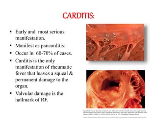 CARDITIS:
 Early and most serious
manifestation.
 Manifest as pancarditis.
 Occur in 60-70% of cases.
 Carditis is the only
manifestation of rheumatic
fever that leaves a squeal &
permanent damage to the
organ.
 Valvular damage is the
hallmark of RF.
 