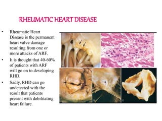 RHEUMATIC HEART DISEASE
• Rheumatic Heart
Disease is the permanent
heart valve damage
resulting from one or
more attacks of ARF.
• It is thought that 40-60%
of patients with ARF
will go on to developing
RHD.
• Sadly, RHD can go
undetected with the
result that patients
present with debilitating
heart failure.
 
