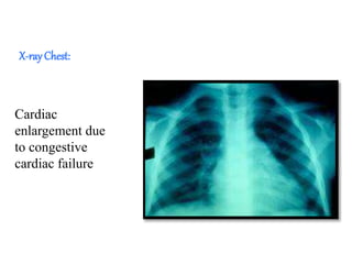X-rayChest:
Cardiac
enlargement due
to congestive
cardiac failure
 