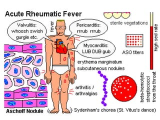 Rheumatic fever