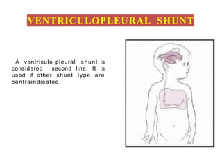 Ventriculo-Pleural Shunt