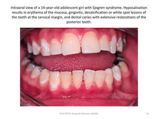 Intraoral view of a 14-year-old adolescent girl with Sjogren syndrome. Hyposalivation
results in erythema of the mucosa, g...