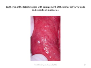 Erythema of the labial mucosa with enlargement of the minor salivary glands
and superficial mucoceles.
Prof DR Dr Ariyanto...