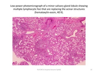 Low-power photomicrograph of a minor salivary gland lobule showing
multiple lymphocytic foci that are replacing the acinar...