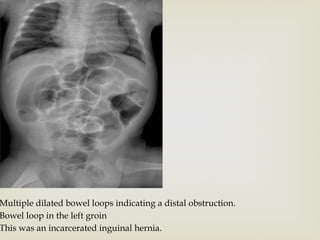 Pediatric Small and Larg Bowl. acute abdomen in neonates .pptx