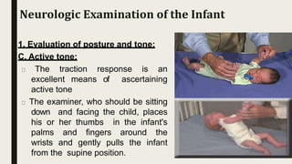 1. Evaluation of posture and tone:
C. Active tone:
The traction response is an
excellent means of ascertaining
active tone
The examiner, who should be sitting
down and facing the child, places
his or her thumbs in the infant's
palms and fingers around the
wrists and gently pulls the infant
from the supine position.
Neurologic Examination of the Infant
 