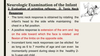 2. Evaluation of primitive reflexes: D. Tonic Neck
Response
• The tonic neck response is obtained by rotating the
infant's head to the side while maintaining the
chest in a flat position.
• A positive response is extension of the arm and leg
on the side toward which the face is rotated and
flexion of the limbs on the opposite side.
• Inconstant tonic neck responses can be elicited for
as long as 6 to 7 months of age and can even be
momentarily present during sleep in the healthy 2-
Neurologic Examination of the Infant
 