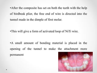 •After the composite has set on both the teeth with the help
of birdbeak plier, the free end of wire is directed into the
tunnel made in the dimple of first molar.
•This will give a form of activated loop of NiTi wire.
•A small amount of bonding material is placed in the
opening of the tunnel to make the attachment more
permanent
 