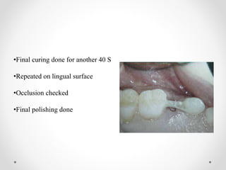•Final curing done for another 40 S
•Repeated on lingual surface
•Occlusion checked
•Final polishing done
 
