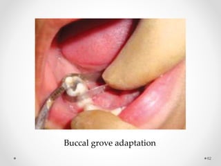 62
Buccal grove adaptation
 