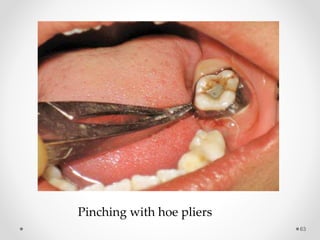 63
Pinching with hoe pliers
 