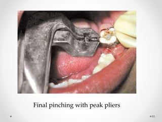 65
Final pinching with peak pliers
 