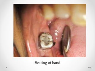 68
Seating of band
 