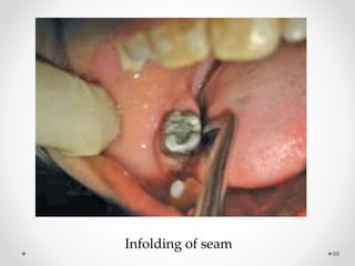 69
Infolding of seam
 