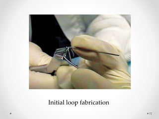 72
Initial loop fabrication
 
