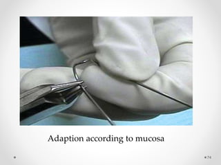 74
Adaption according to mucosa
 