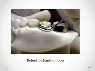 76
Retentive band of loop
 