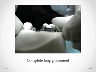 77
Complete loop placement
 