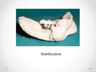 79
Stabilization
 