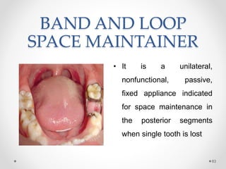 BAND AND LOOP
SPACE MAINTAINER
• It is a unilateral,
nonfunctional, passive,
fixed appliance indicated
for space maintenance in
the posterior segments
when single tooth is lost
83
 