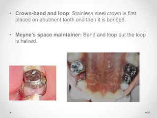 • Crown-band and loop: Stainless steel crown is first
placed on abutment tooth and then it is banded.
• Meyne’s space maintainer: Band and loop but the loop
is halved.
87
 