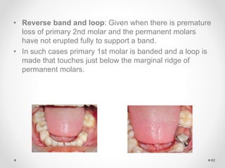 • Reverse band and loop: Given when there is premature
loss of primary 2nd molar and the permanent molars
have not erupted fully to support a band.
• In such cases primary 1st molar is banded and a loop is
made that touches just below the marginal ridge of
permanent molars.
88
 