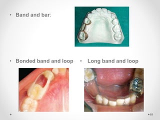 • Band and bar:
• Bonded band and loop • Long band and loop
89
 