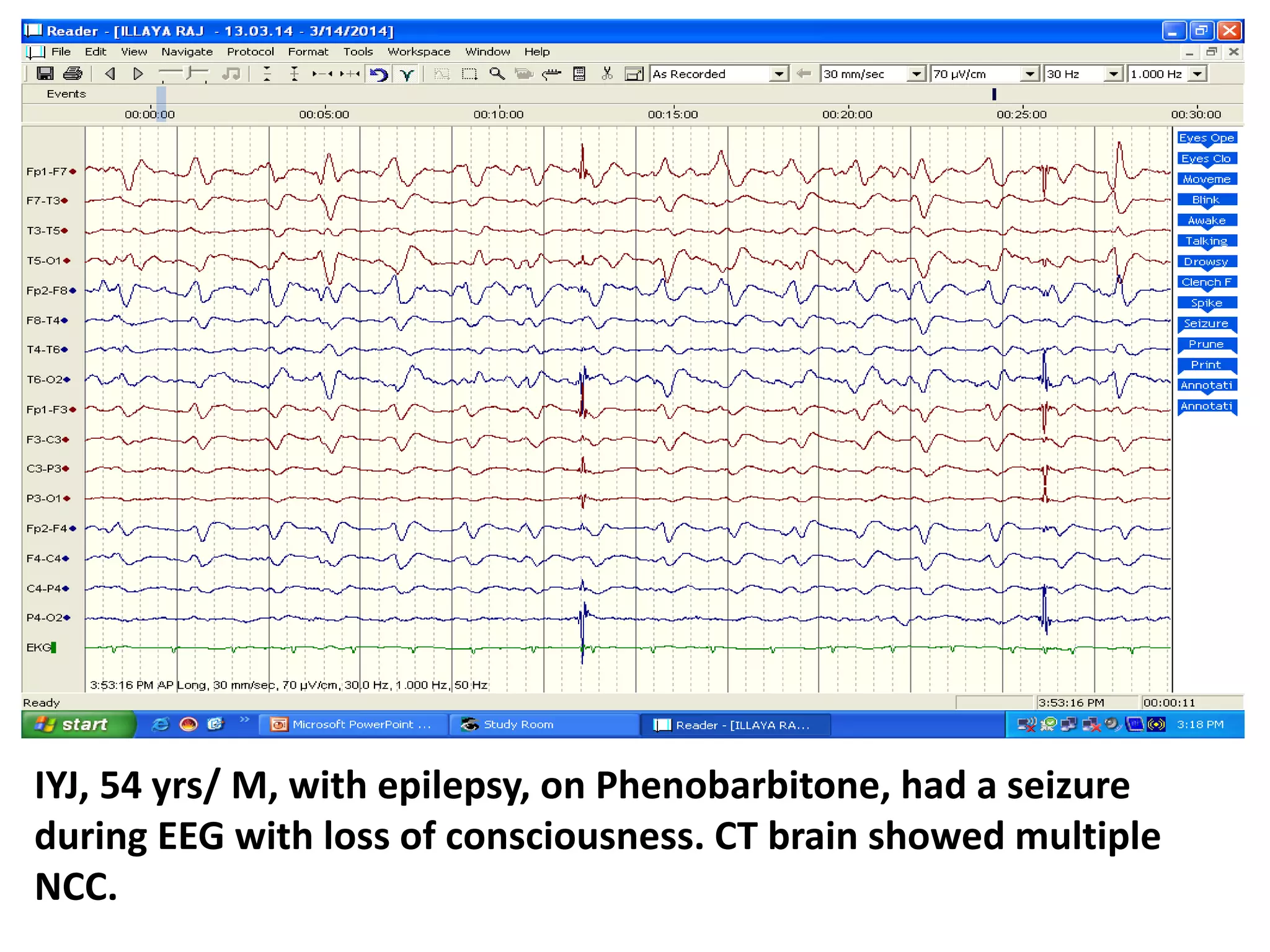 IYJ, 54 yrs/ M, with epilepsy, on Phenobarbitone, had a seizure
during EEG with loss of consciousness. CT brain showed multiple
NCC.
 