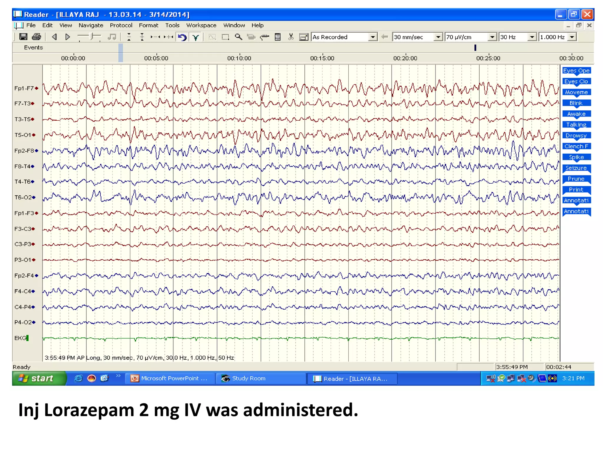 Inj Lorazepam 2 mg IV was administered.
 