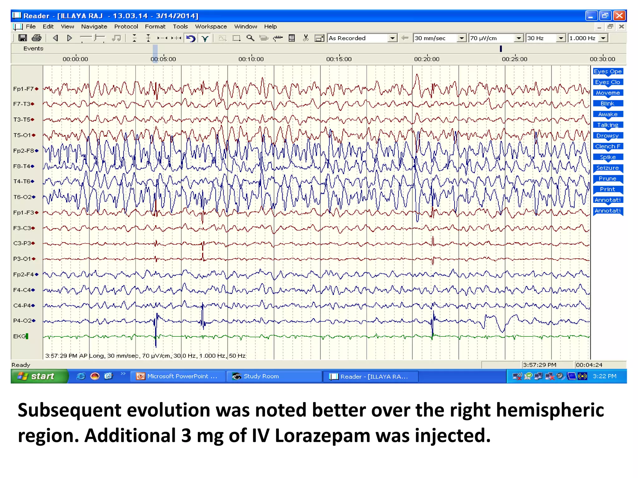Subsequent evolution was noted better over the right hemispheric
region. Additional 3 mg of IV Lorazepam was injected.
 