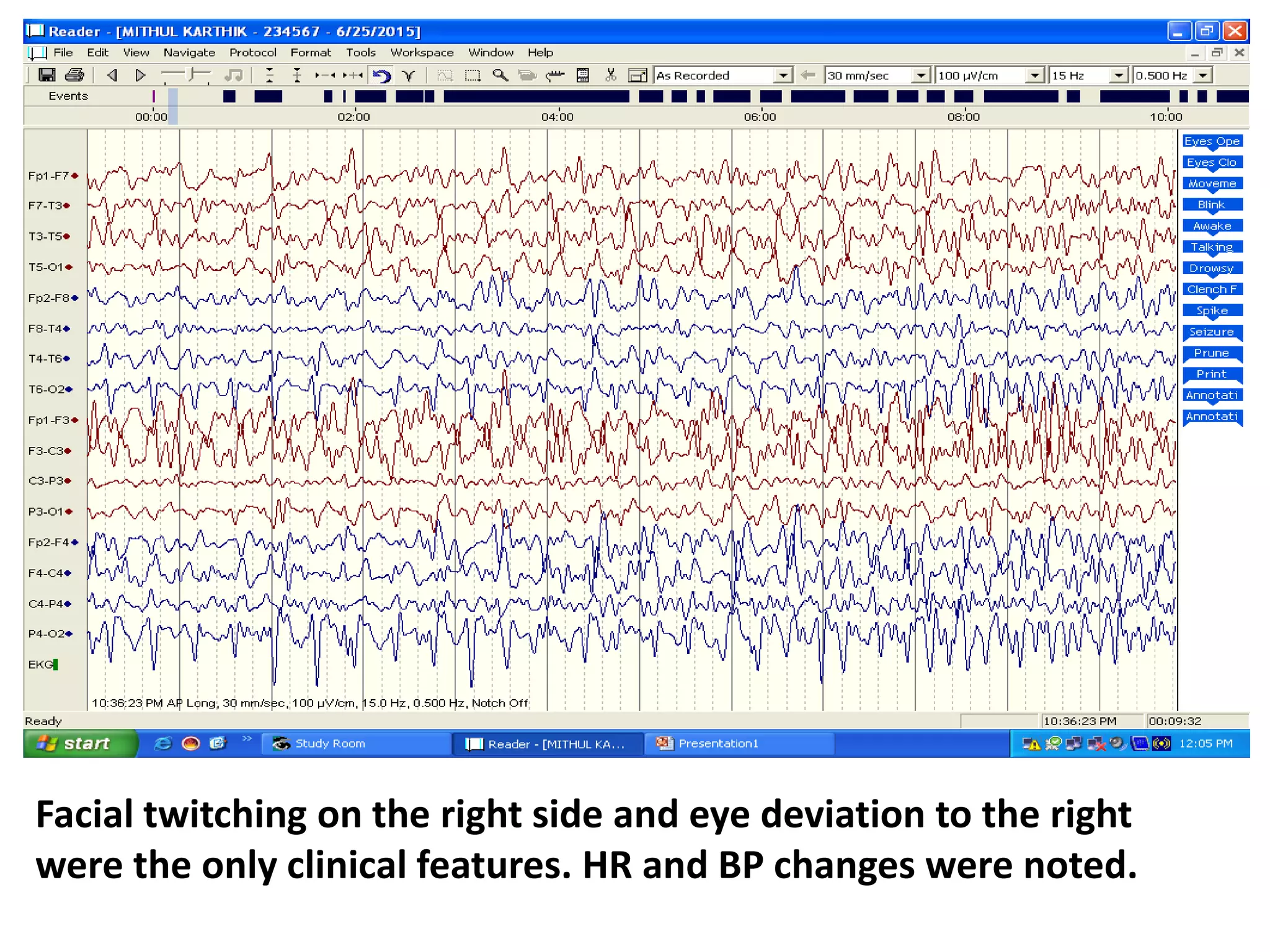 Facial twitching on the right side and eye deviation to the right
were the only clinical features. HR and BP changes were noted.
 