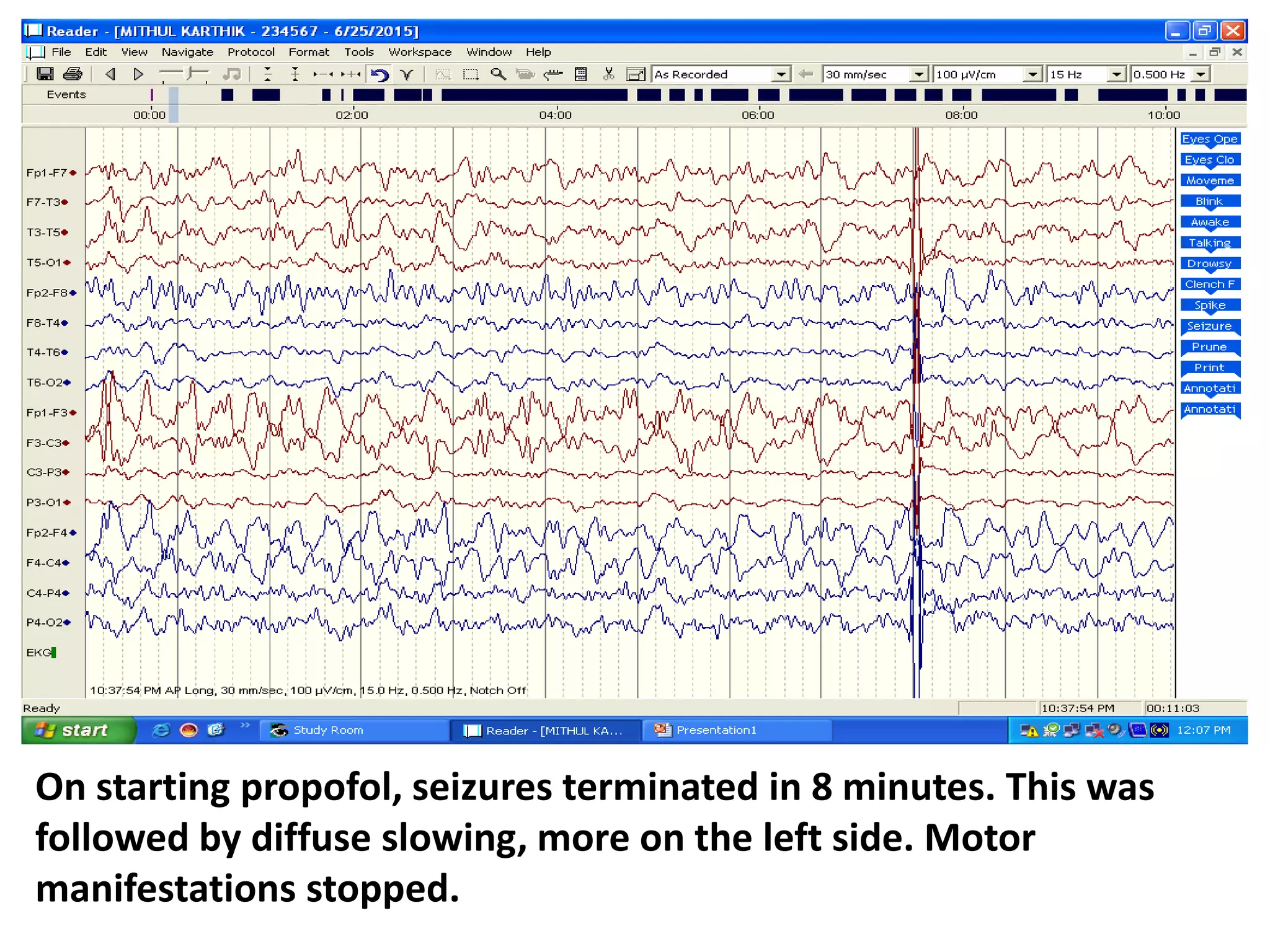 On starting propofol, seizures terminated in 8 minutes. This was
followed by diffuse slowing, more on the left side. Motor
manifestations stopped.
 