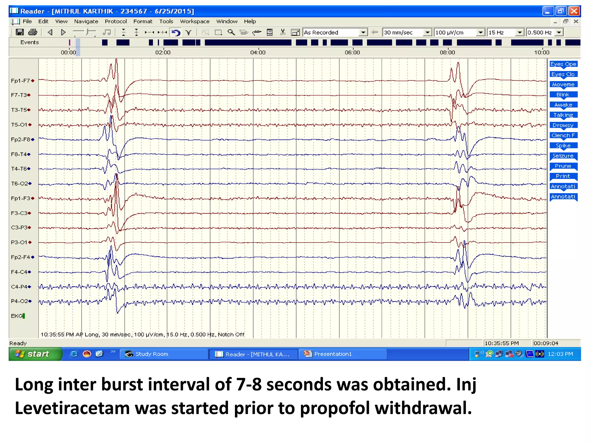 Long inter burst interval of 7-8 seconds was obtained. Inj
Levetiracetam was started prior to propofol withdrawal.
 