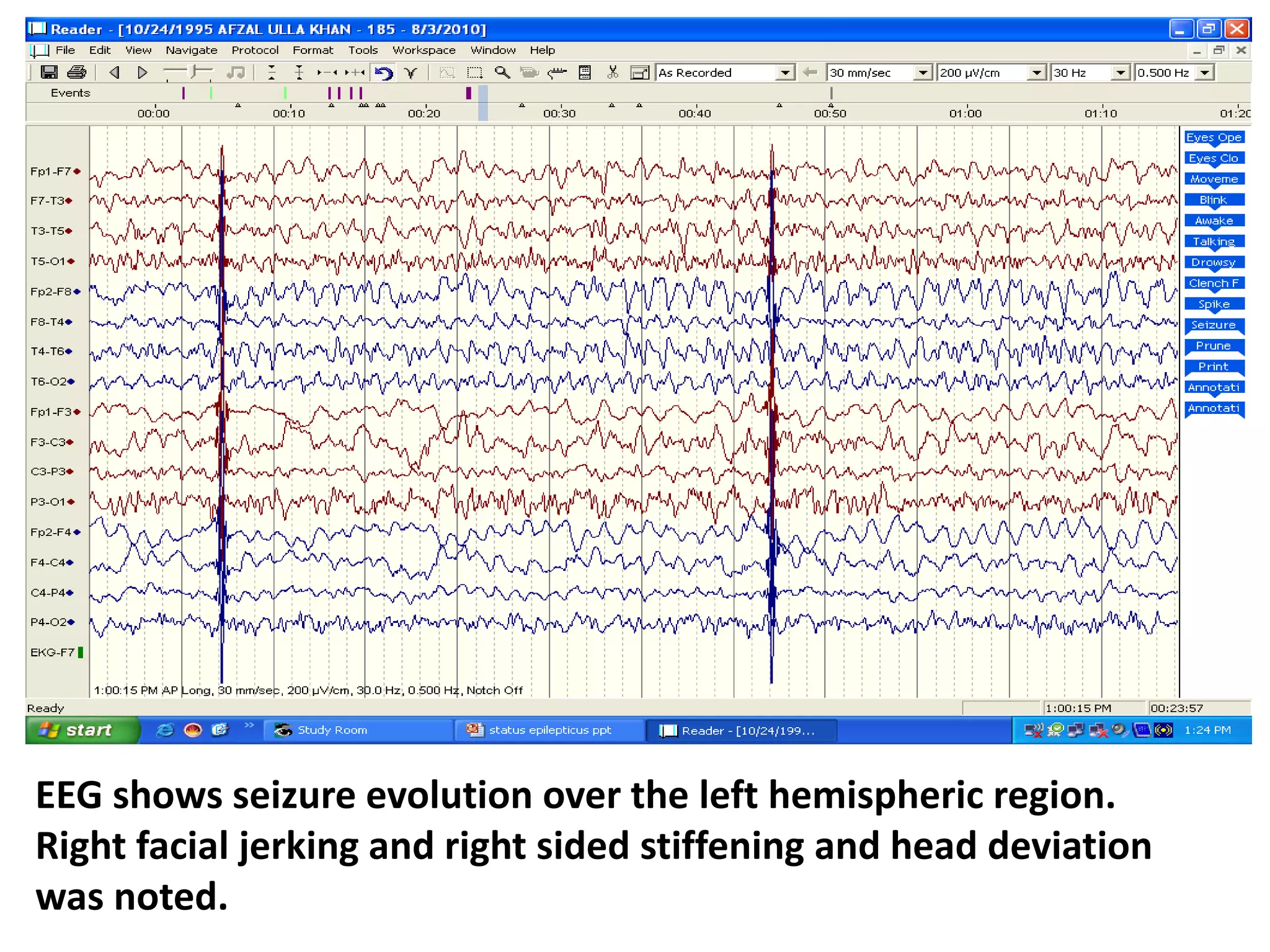 EEG shows seizure evolution over the left hemispheric region.
Right facial jerking and right sided stiffening and head deviation
was noted.
 