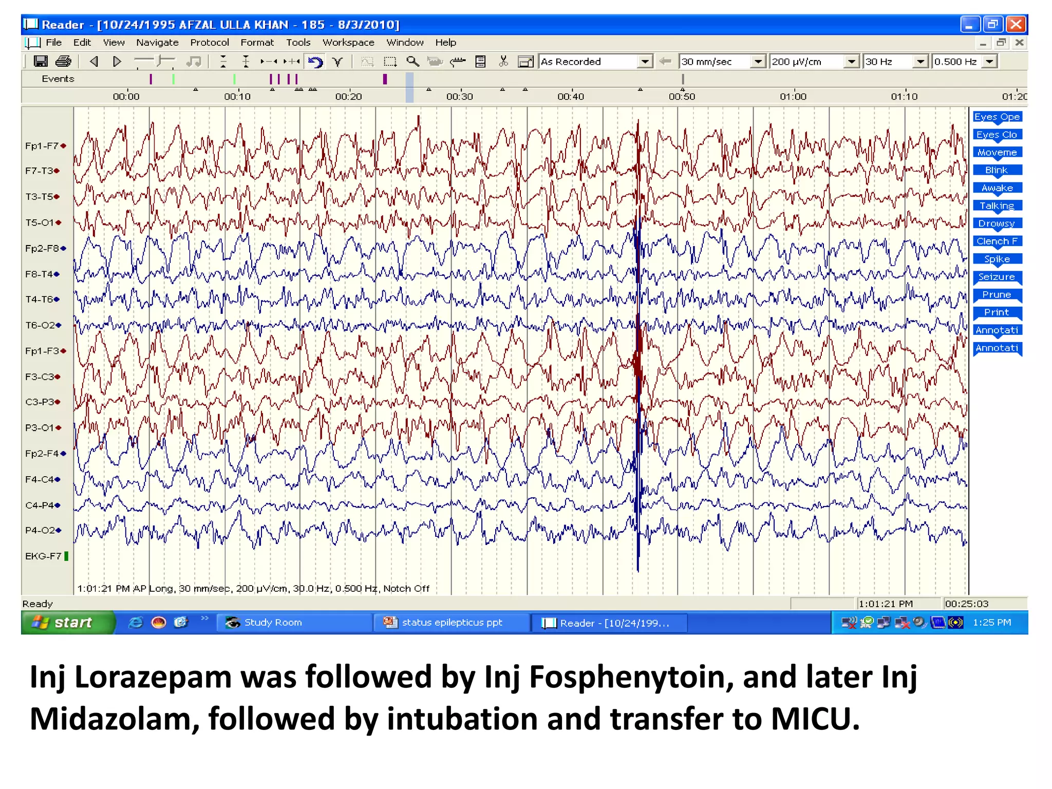 Inj Lorazepam was followed by Inj Fosphenytoin, and later Inj
Midazolam, followed by intubation and transfer to MICU.
 