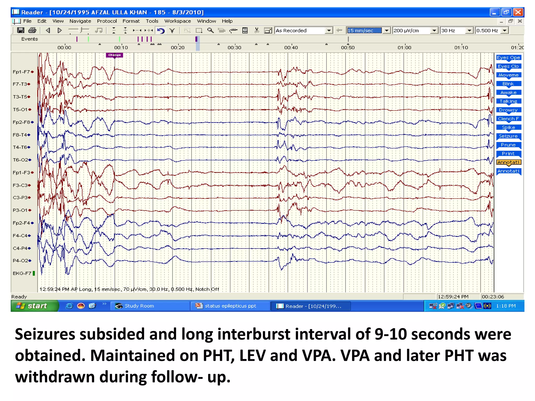 Seizures subsided and long interburst interval of 9-10 seconds were
obtained. Maintained on PHT, LEV and VPA. VPA and later PHT was
withdrawn during follow- up.
 