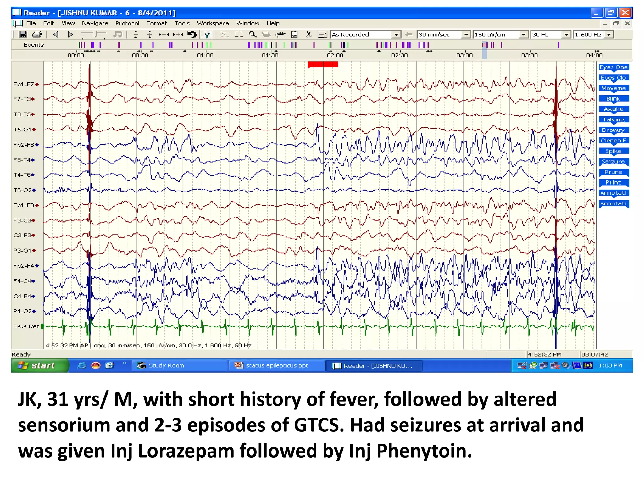 JK, 31 yrs/ M, with short history of fever, followed by altered
sensorium and 2-3 episodes of GTCS. Had seizures at arrival and
was given Inj Lorazepam followed by Inj Phenytoin.
 